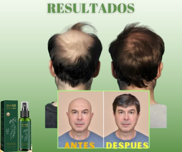EUHOE CAIDA DE CABELLO// Delivery gratis